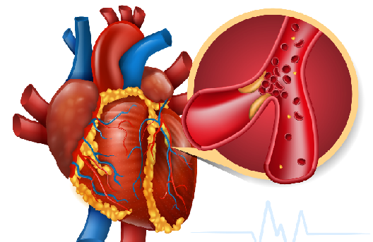 Coronary Artery Disease